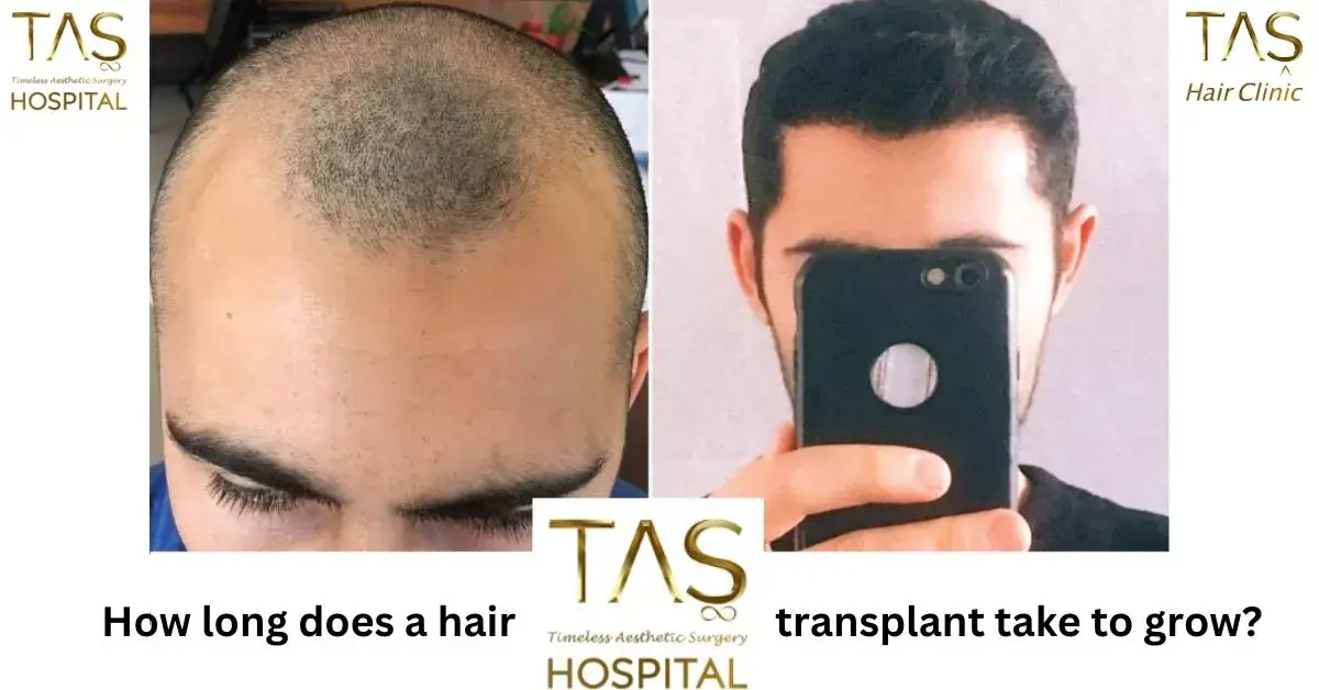 how long does a hair transplant take to grow