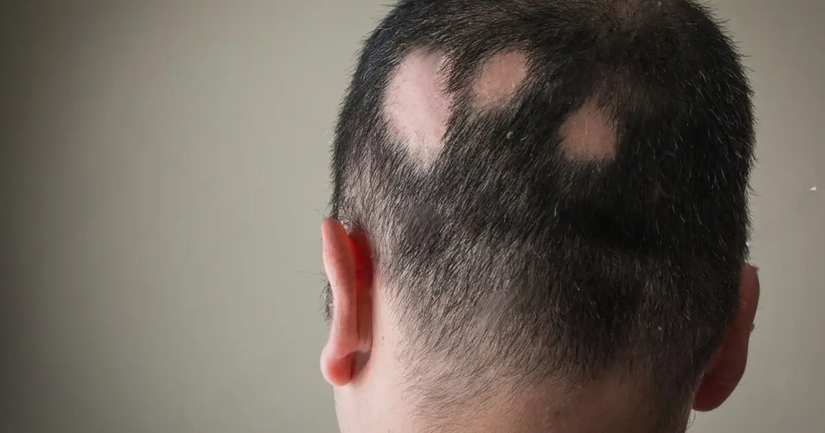 Patchy Hair loss – Alopecia Areata