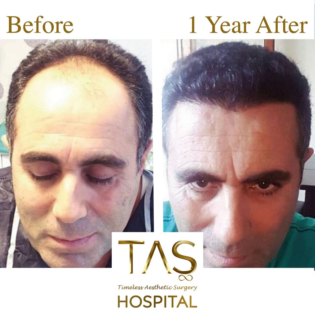 Hair Transplant Before and One Year After