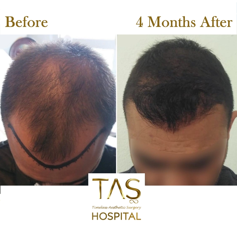Hair Transplant Before and 4 Monts After