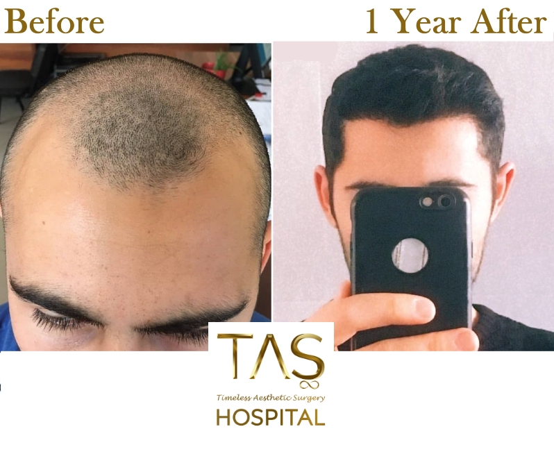 Hair Transplant Before and 1 Year After