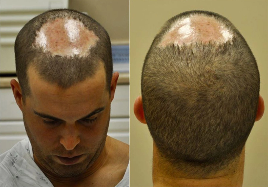 Scarring after hair Transplant