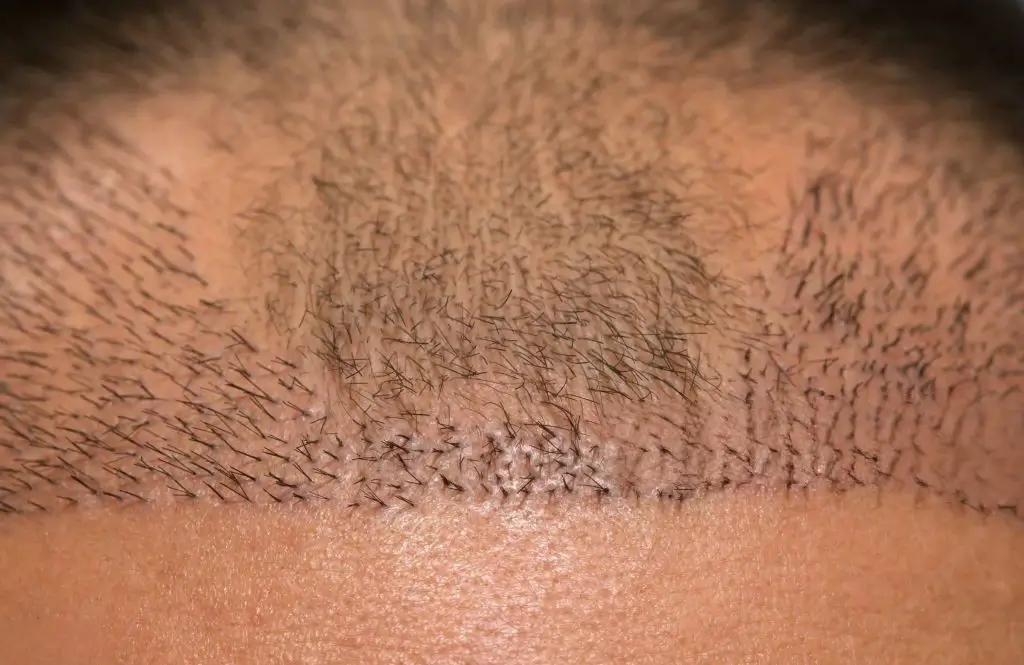 Scarring after hair transplant
