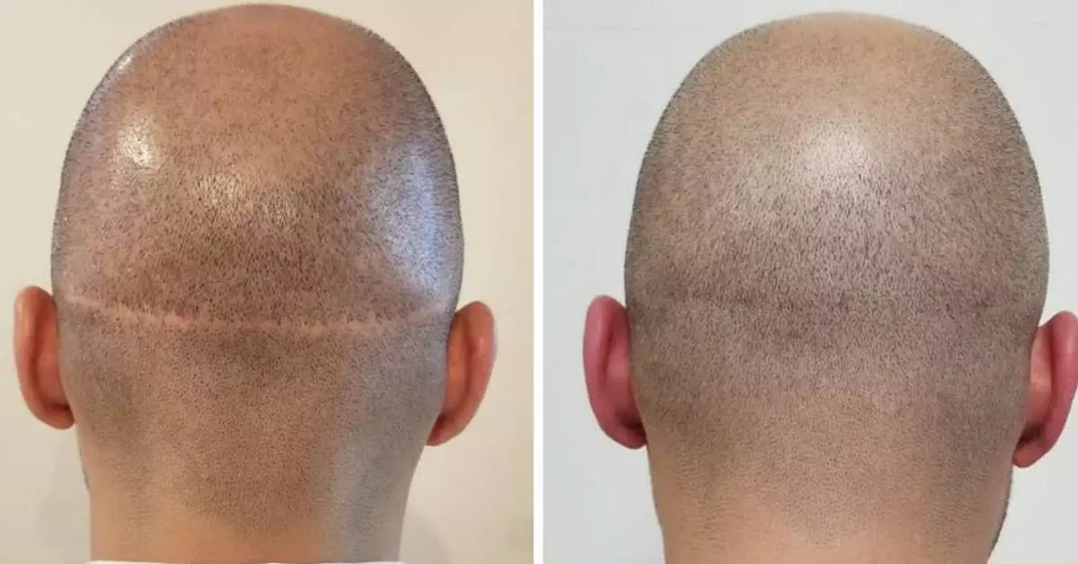 Scars after Hair Transplant