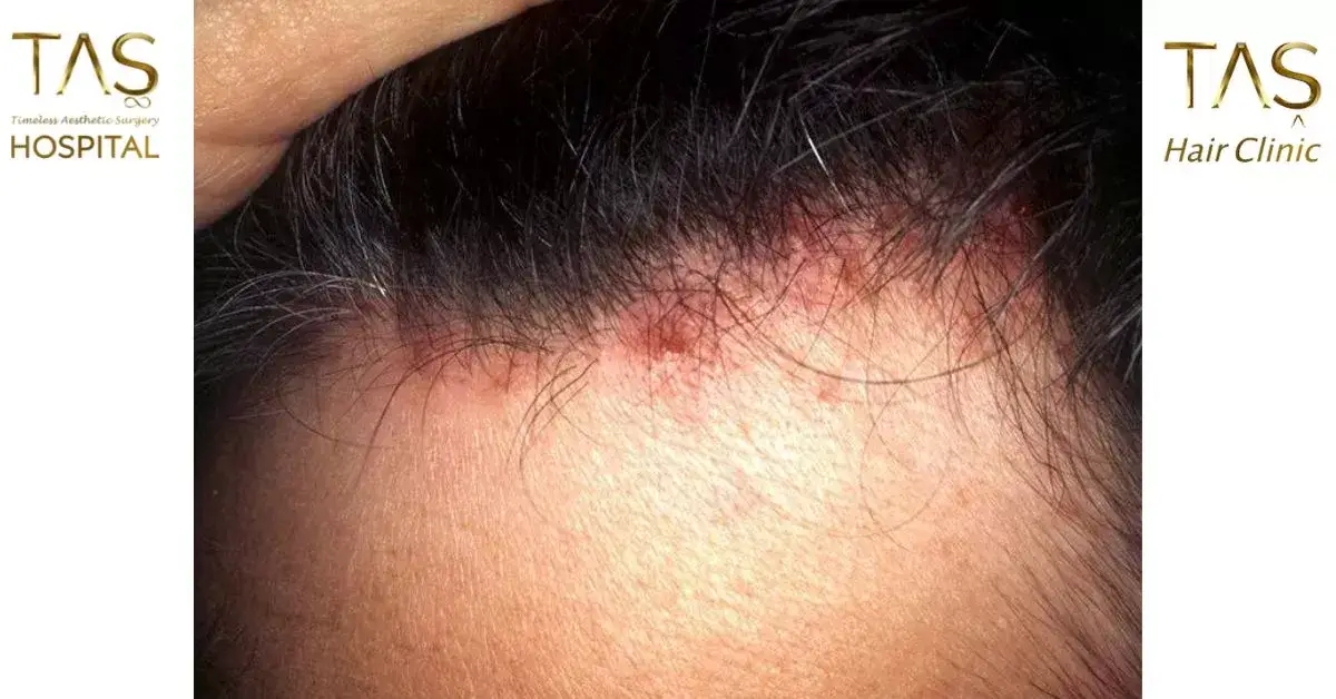 Why do I have scalp pain while moving my Hair?