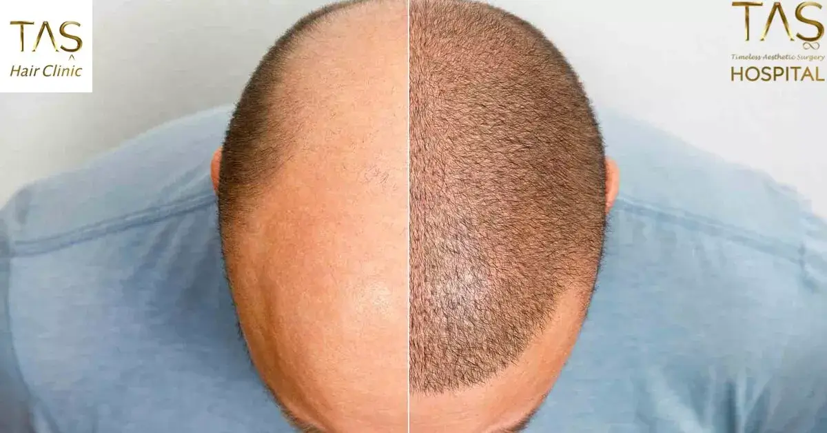 5000 grafts Hair Transplant cost USA – Cost, Coverage, and Comparison of Prices with Turkey