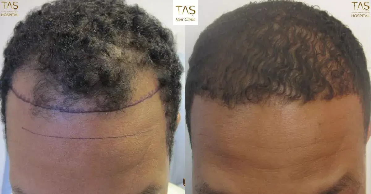 African America Hair Transplant