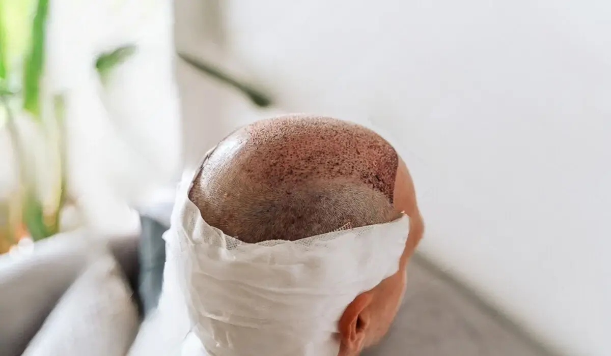 Hair Transplant after care